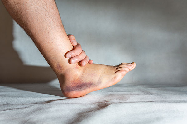 Ankle Sprains image of foot