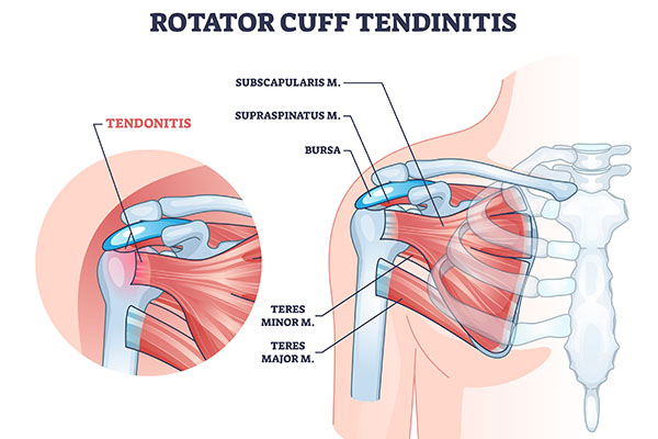 Rotator Cuff Tendinitis image